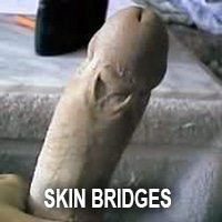 what is circumcision botches skin adhesions bridges