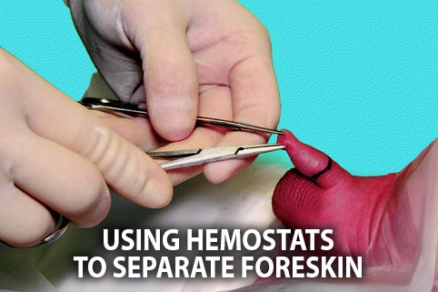 circumcision hemostat procedure foreskin